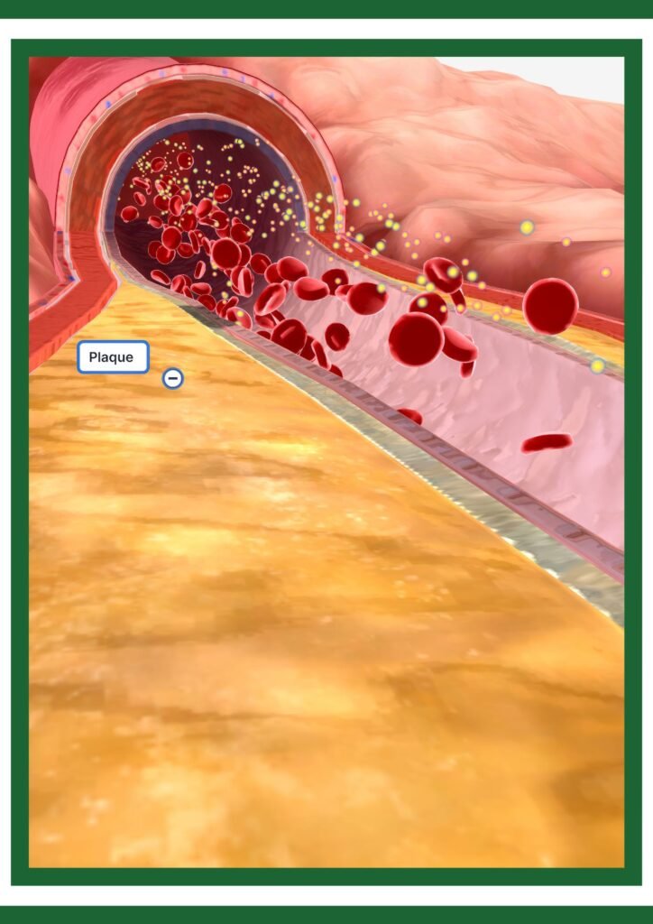 "Breakthrough Nanoparticle Therapy Dissolves Artery Plaques, Offering New Hope for Heart Health"